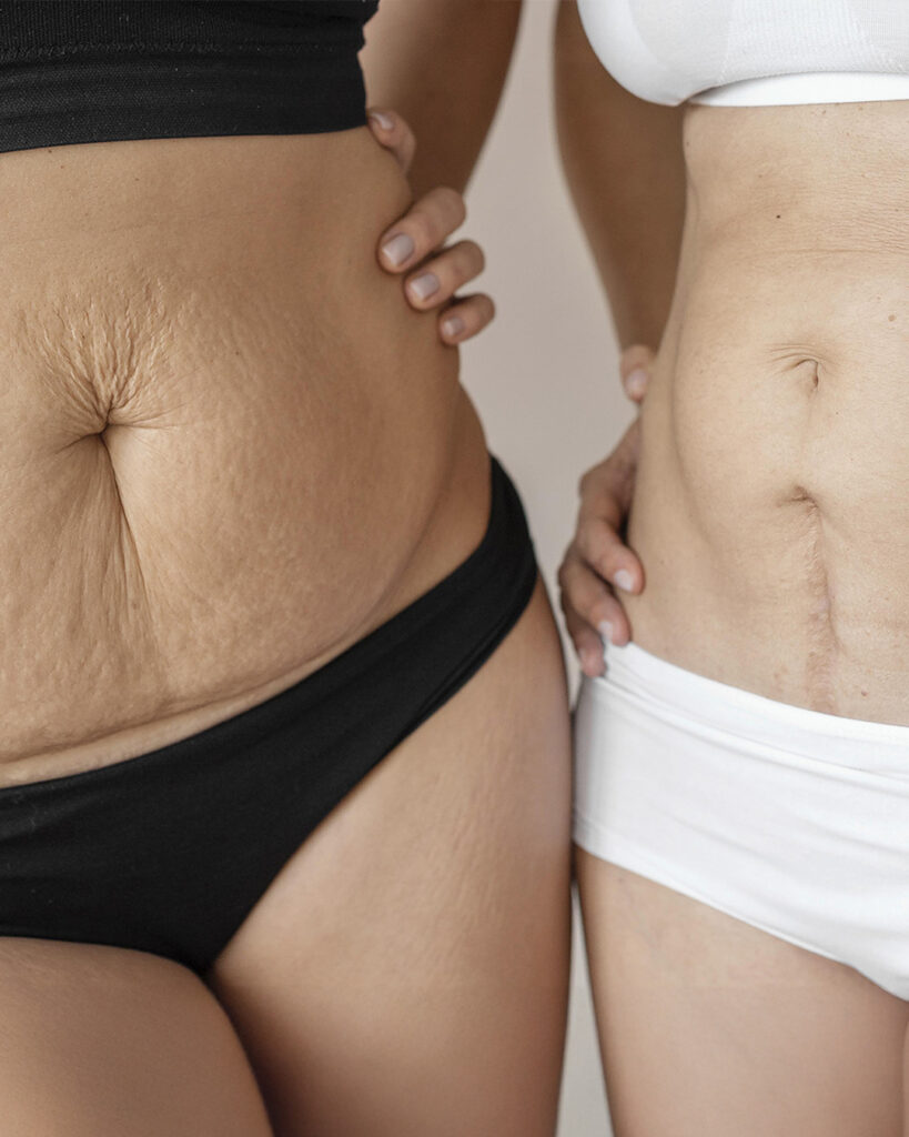 Quando decidimos emagrecer — seja por dieta, exercícios ou cirurgia bariátrica — imaginamos um corpo mais saudável e com contornos mais definidos...