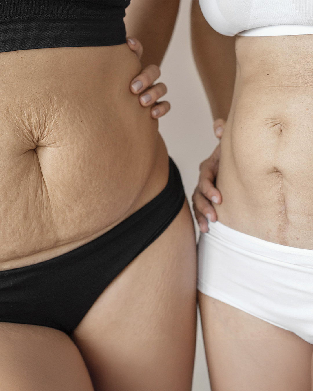Quando decidimos emagrecer — seja por dieta, exercícios ou cirurgia bariátrica — imaginamos um corpo mais saudável e com contornos mais definidos...